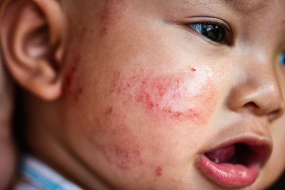 Eczema, Food Allergy Hives And 6 Other Common Baby Rashes: How To Tell The Difference