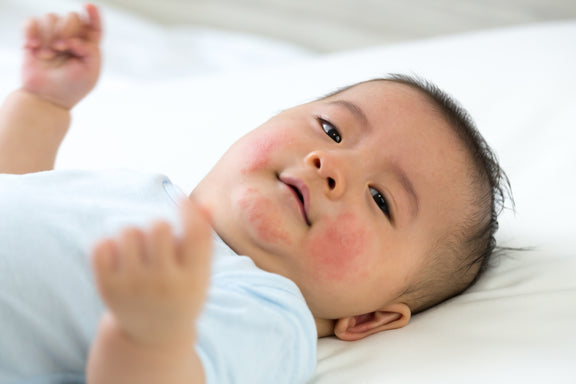 Is My Baby Having an Allergic Reaction? And What Parents Need to Know About Early Allergen Introduction