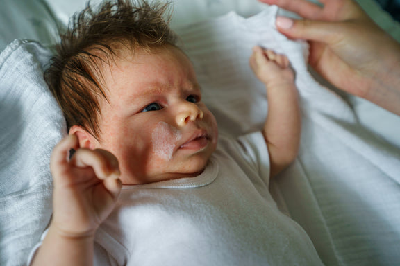 Skin Barrier 101: Caring For Eczema Babies