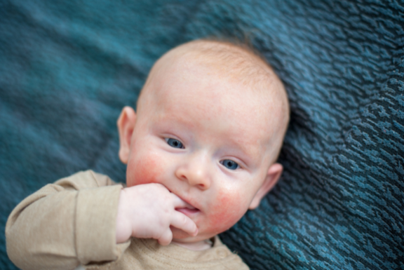 Is Redness a Symptom of a Food Allergy Reaction?
