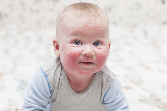 Baby with eczema with a white background