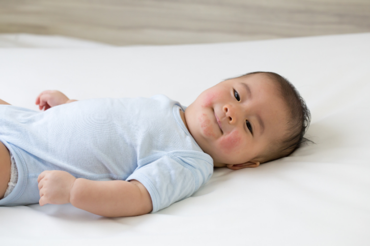 Baby Eczema: The Essential Guide for Parents of Babies with Eczema