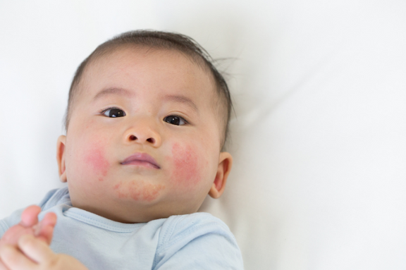 Does My Baby Have A Food Allergy Rash? Plus, Symptoms, Causes and How To Manage