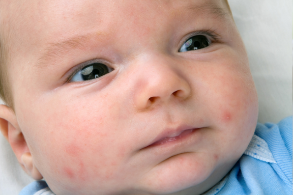 Baby Acne: What Does It Look Like? How To Treat?
