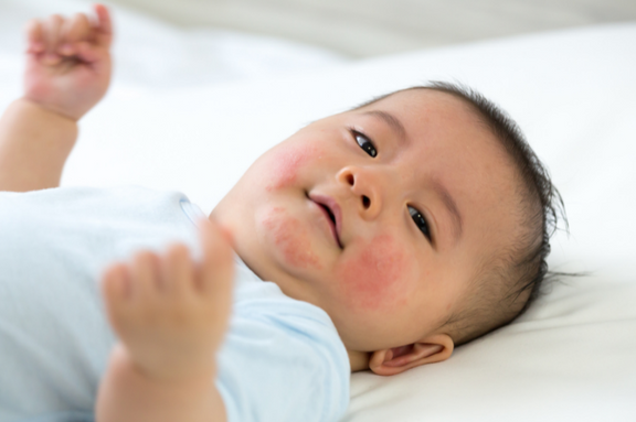 Does My Baby Have Hives? Identifying Hives From A Food Allergy