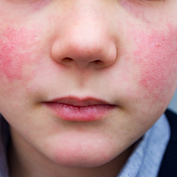 What Is Fifth Disease (Parvovirus B19) In Children?