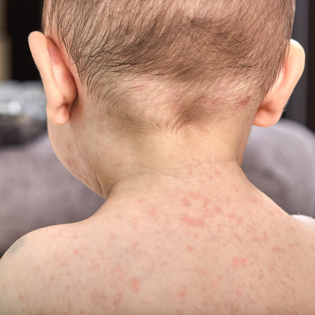 What is Roseola or Sixth Disease In Children?