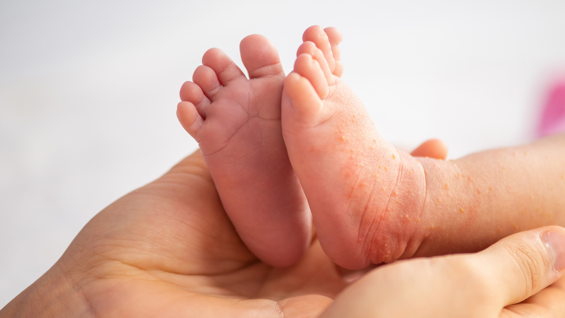 A Parent’s Guide To Dyshidrotic Eczema
