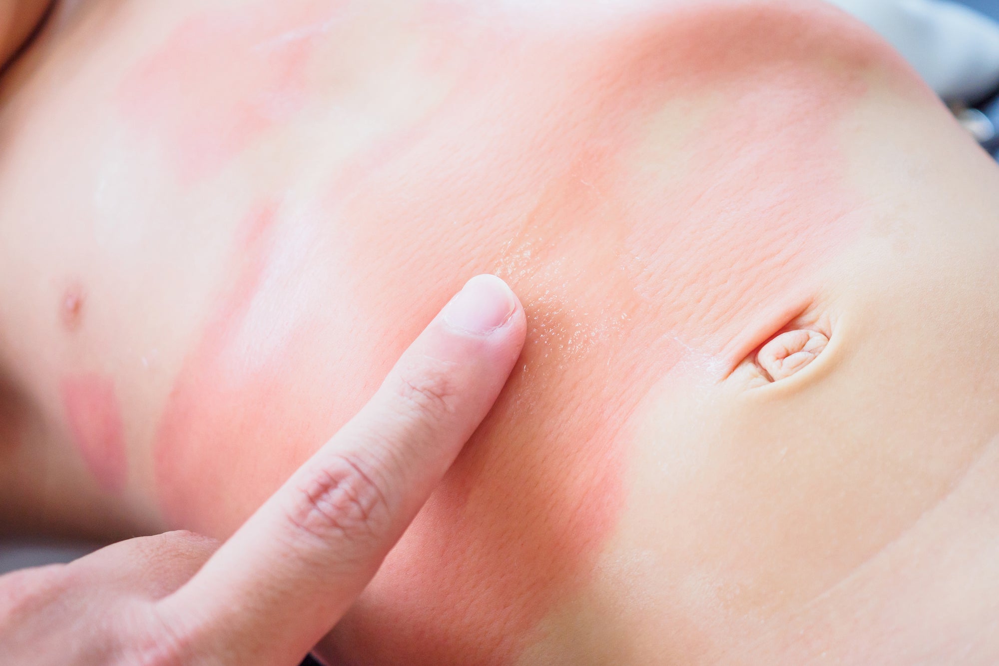 4 Reasons Your Baby Can Break Out In Hives