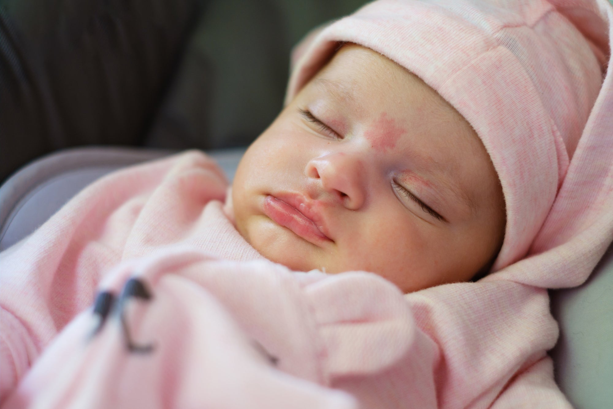 Port-Wine Stain (Nevus Flammeus) In Babies: What Parents Need To Know