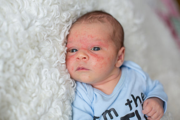 Types of Baby Eczema