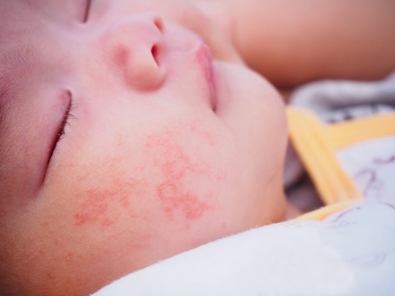 Do Food Allergies Cause Eczema?