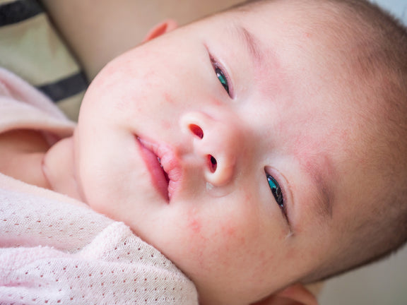 Baby Eczema And Food Allergies: What Parents Need To Know
