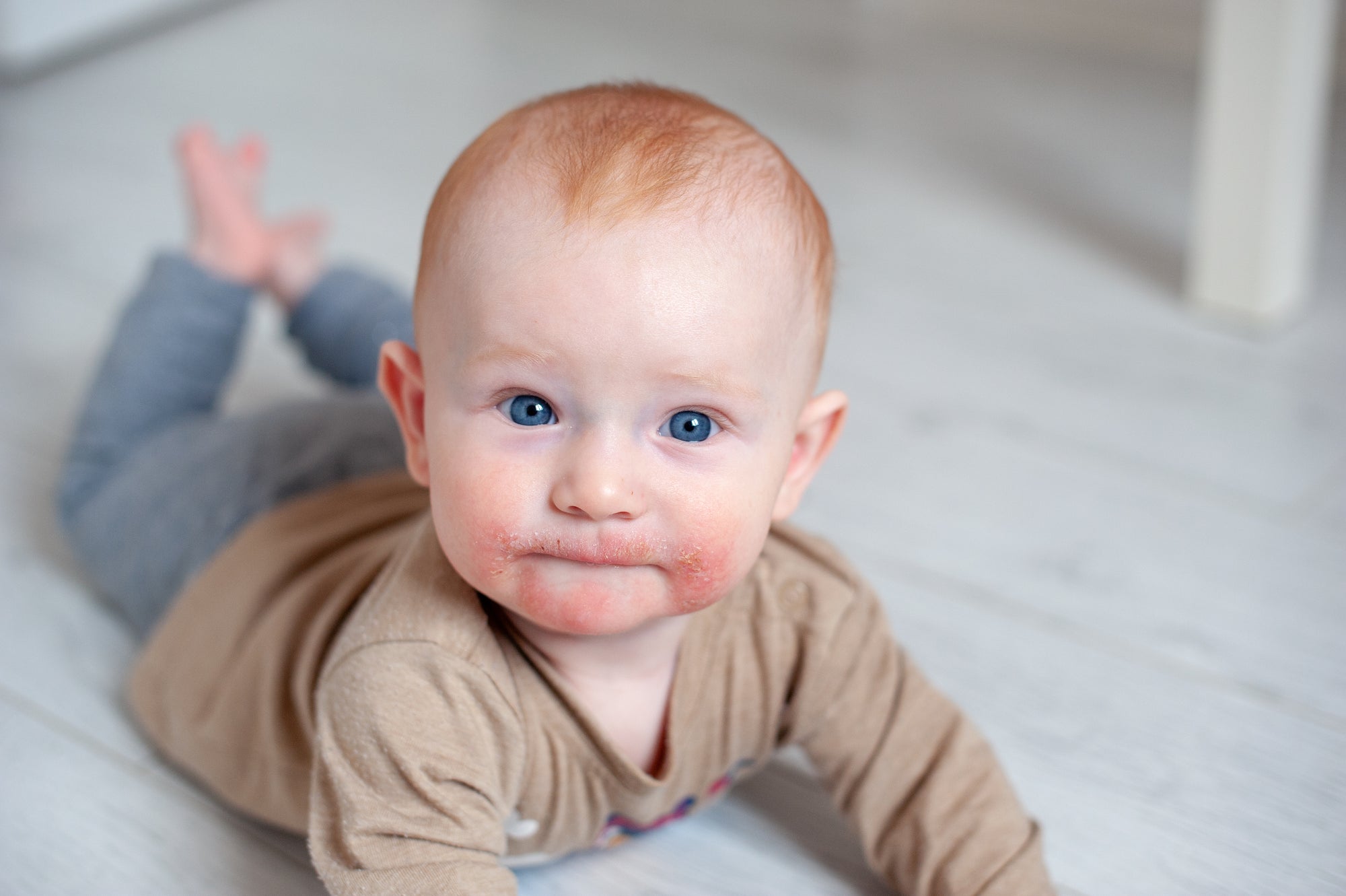 Baby Eczema: Causes and Triggers