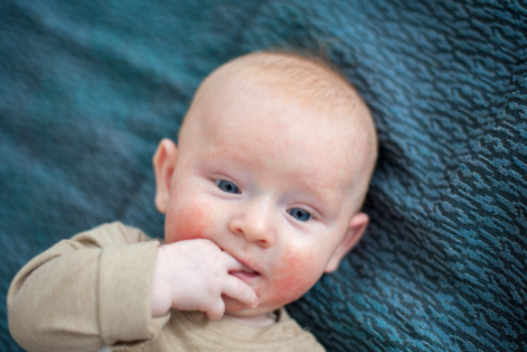 Is Redness a Symptom of a Food Allergy Reaction?