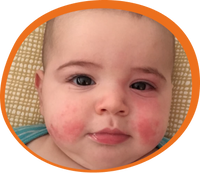 Baby with eczema rash on face