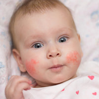 Baby with eczema on cheeks